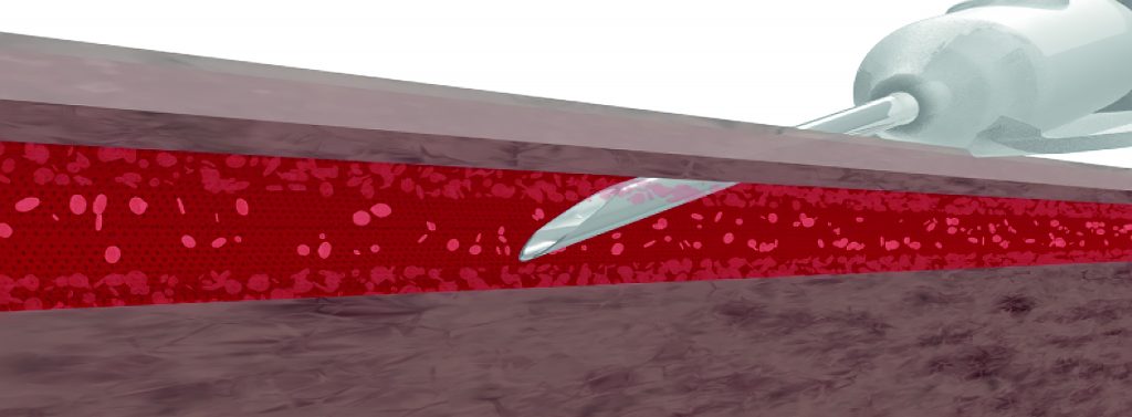 Bevel Only Technique
